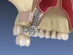 Sinus Lifting